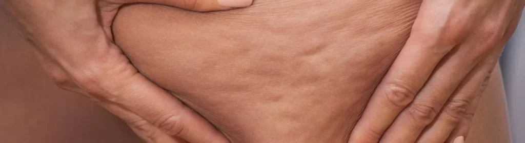 Profissionais de estética podem oferecer diversos tratamentos para celulite e acabar com um dos problemas que mais insatisfazem mulheres. Foto de uma perna sendo apertada com a mão para mostrar celulites.