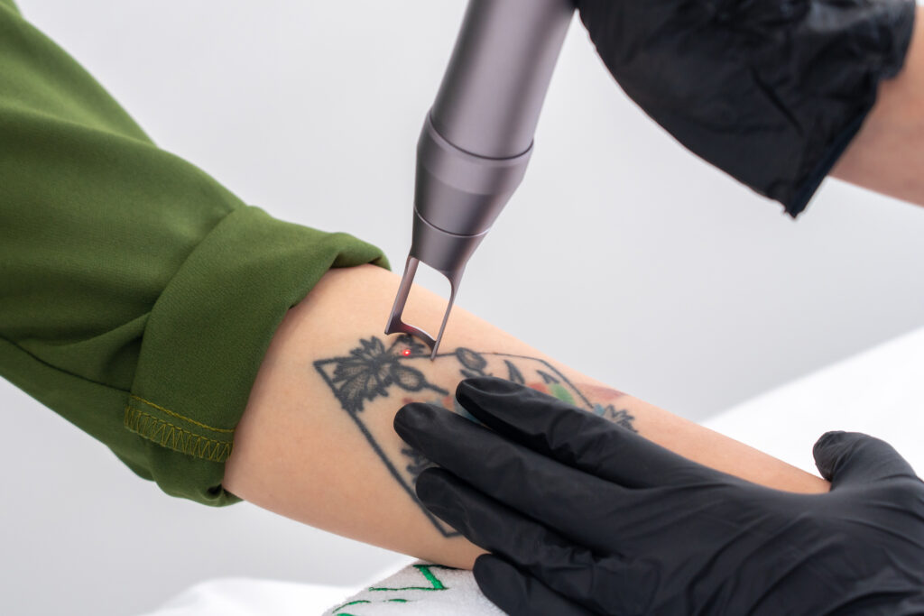 Laser para remoção de tatuagem