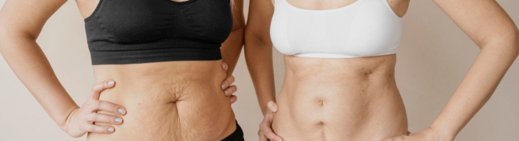 Mulheres com flacidez corporal na região da barriga